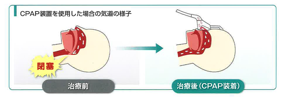 CPAP装置を使用した場合の気道の様子